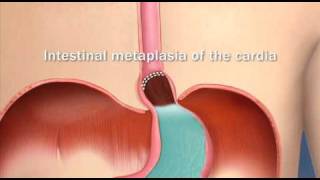 Barretts Esophagus Intestinal Metaplasia of the CardiaMayo Clinic [upl. by Hendrickson]