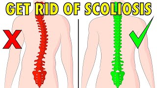 Do These Exercises Every Day To Fix Scoliosis Naturally [upl. by Kere]