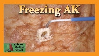 Freezing Hand Actinic Keratosis with Liquid Nitrogen  Auburn Medical Group [upl. by Cooley]