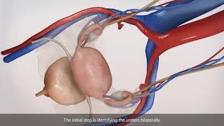 Laparoscopic bilateral salpingooophorectomy BSO [upl. by Llerehc]