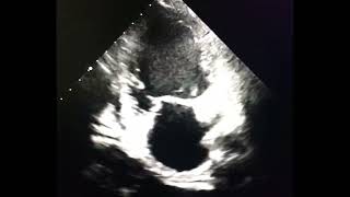 Mitral valve tenting to drahmadmirdamadisiB9IXNBgK1a0PFDgj [upl. by Opportuna905]