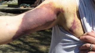 Bruise Hematoma blue spots on skin causes and treatment [upl. by Gnek]