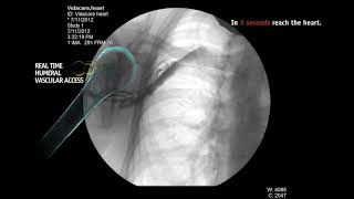 Intraosseous Infusion From Right Humeral Head [upl. by Airetnuhs288]