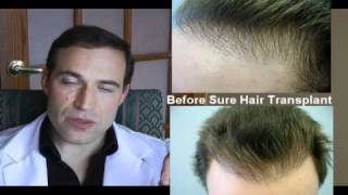 Amazing Hair transplant repair Toronto Canada  4167477873 [upl. by Genovera]