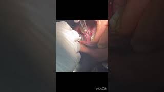 Early Diagnosis amp Timely Treatment of Leukoplakia Your Best Defense oralrehabilitation oralcancer [upl. by Oznecniv]