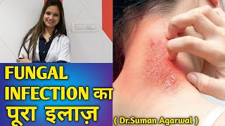 फंगल इन्फेक्शन का पूरा इलाज़  fungal infections by dermatologist Dr Suman Agarwal [upl. by Accebor]