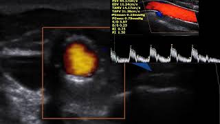 Pósoperatório tardio de angioplastia de carótida [upl. by Ardnuat]