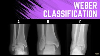 Weber Classification Ankle Fractures [upl. by Ule]