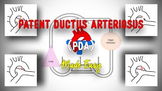 PDA • Patent Ductus Arteriosus • Anatomy • Pathophysiology • Clinical features • Made Easy [upl. by Akselaw]