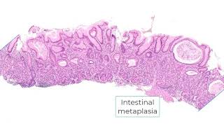 Autoimmune gastritis and differential diagnosis [upl. by Nitsirk]