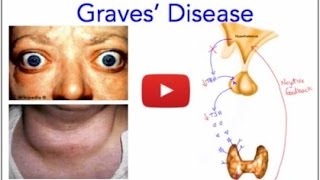 Graves Disease  Hyperthyroidism  Everything You Need to Know  MADE EASY [upl. by Essilevi]