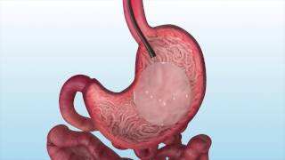 Orbera Intragastric Balloon Patient Animation [upl. by Shoemaker]