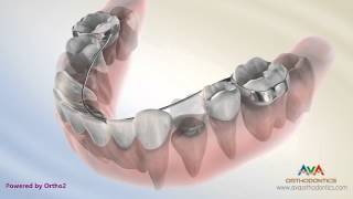 Orthodontic Space Management  Lingual Arch Appliance [upl. by Eelsew]