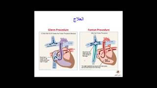 Hypoplastic Left Heart Syndrome HLHS د علي الاخفش  متلازمة القلب الأيسر ناقص التنسج [upl. by Gessner]