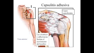 Capsulitis Adhesiva en hombro👉 Terapia  Rehabilitación [upl. by Haleak]