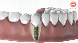 Vidéo de démonstration pour une pose dimplant dentaire [upl. by Ella]