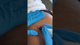 Stretch Marks Inkless Removal Boleyn Treatment Los Angeles 🌍 shorts [upl. by Calie]