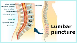 lumbar puncture [upl. by Stockwell443]