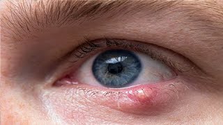 how to get rid of a stye that wont go away [upl. by Naujd]