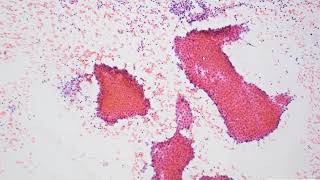 Warthin tumour cytology with differential diagnoses [upl. by Dante]