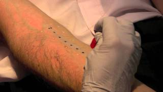 Skin Prick Allergy Test [upl. by Neyud]