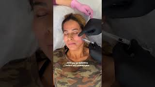 One of the BEST Treatments for Facial Volume Loss [upl. by Amieva583]