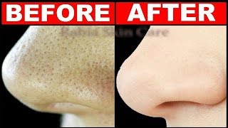 How To Get Rid of LARGE PORES in 3 Days  Best Home Remedies For Open Pores Treatment [upl. by Beverle]