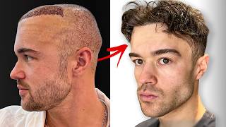 6 Month Hair Transplant Journey Full Recovery [upl. by Atteinotna]