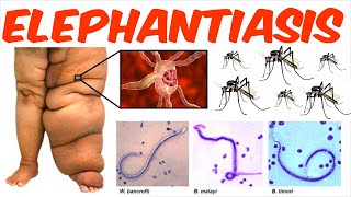 Lymphatic Filariasis  Elephantiasis [upl. by Nimzay]