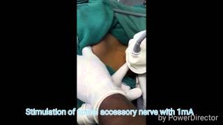 Ultrasound guided spinal accessory nerve block [upl. by Hourihan10]