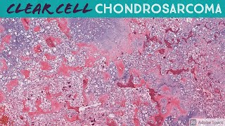 Clear Cell Chondrosarcoma [upl. by Paxon804]