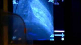 Catheterization and Stent procedure at Mercys Oklahoma Heart Hospital [upl. by Clawson48]