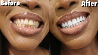 😮 Top 2 Natural Ingredients To Whiten Teeth At Home WITHOUT Hydrogen Peroxide Alkaline [upl. by Ynnek]