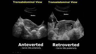 Uterine Positions In Ultrasound  AntevertedRetroverted  AnteflexedRetroflexed Uterus [upl. by Osmund365]