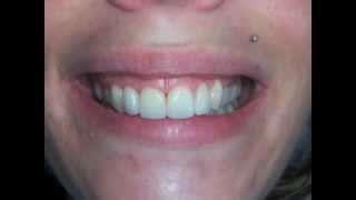 Sourire gingival et facettes dentaires [upl. by Doreen]