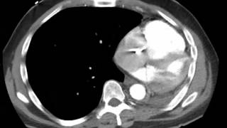 PE post pneumonectomy [upl. by Stockmon]