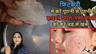 fitkari ke faydeसिर्फ 3 दिन Use कर लो Acne Pimple Tiny Bumps खत्म  How To Use fitkari on face [upl. by Ruiz470]