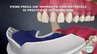 La Corona Protesica capsula dentale [upl. by Siurtemed596]