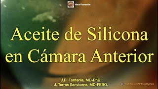 Aceite de Silicona en Cámara Anterior [upl. by Nuarb707]