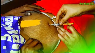 How to inject Filgrastim PFS 30 MIU05 ml Filastin 30  Subcutaneously Navel Injection Push Video [upl. by Sdlonyer]