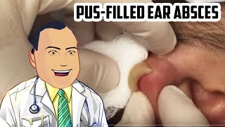 PusFilled Ear Abscess Drained  Revisited Popping [upl. by Enilemme]