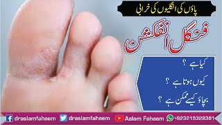 How to Get Rid of Fungal Infection of Feet Athletes Foot HindiUrdu  Fungal Infection Home Remedy [upl. by Bj]