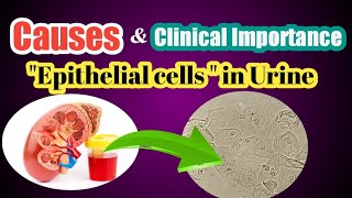 Epithelial Cells in Urine Test  Causes amp Symptoms Of Epithelial Cells in Urine  Urine Analysis [upl. by Kavanaugh]