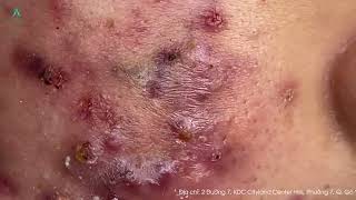 Big Cystic Acne Blackheads Extraction Blackheads amp Milia Whiteheads Removal Pimple Popping [upl. by Aziul]