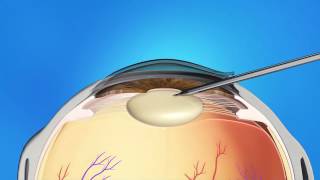 Cataract Surgery Animation [upl. by Rosemarie]