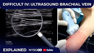 DIFFICULT IV ULTRASOUND GUIDED BRACHIAL VEIN [upl. by Anaud]