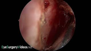 Posteriorly located frontal processlacrimal bone suture line [upl. by Paige]