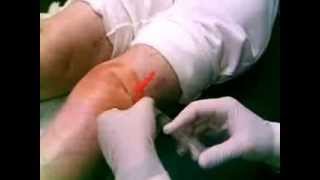 Suprapatellar steroid injection [upl. by Mychal]