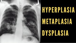 Hyperplasia Metaplasia amp Dysplasia Explained Cancer Biology [upl. by Resarf]