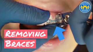 Process of Removing Braces [upl. by Trudie]